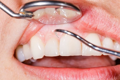 Periodontal dental examination to have a healthy mouth and teeth