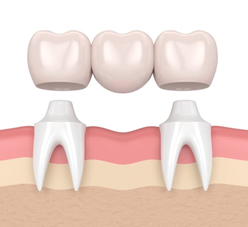 Illustration of a Dental Bridge