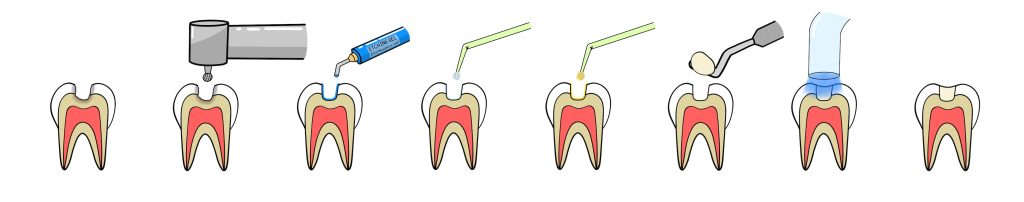 Illustration showing the process of filling a tooth.