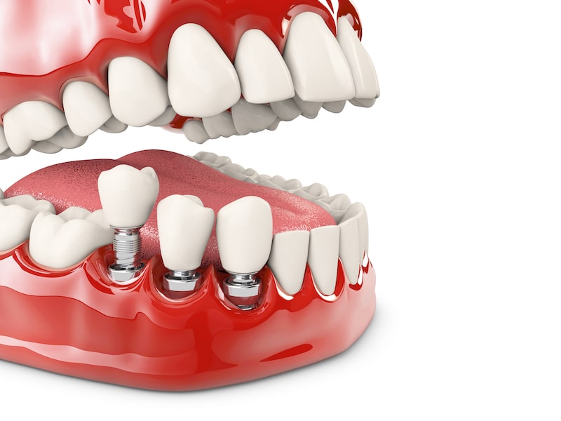 Vector illustration showing a dental implant.