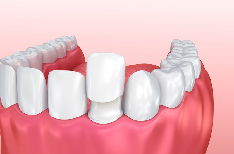 Vector illustration of dental veneer