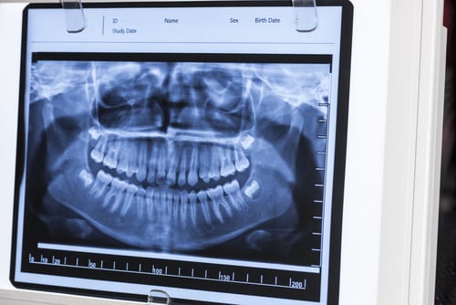 Dental X-Ray