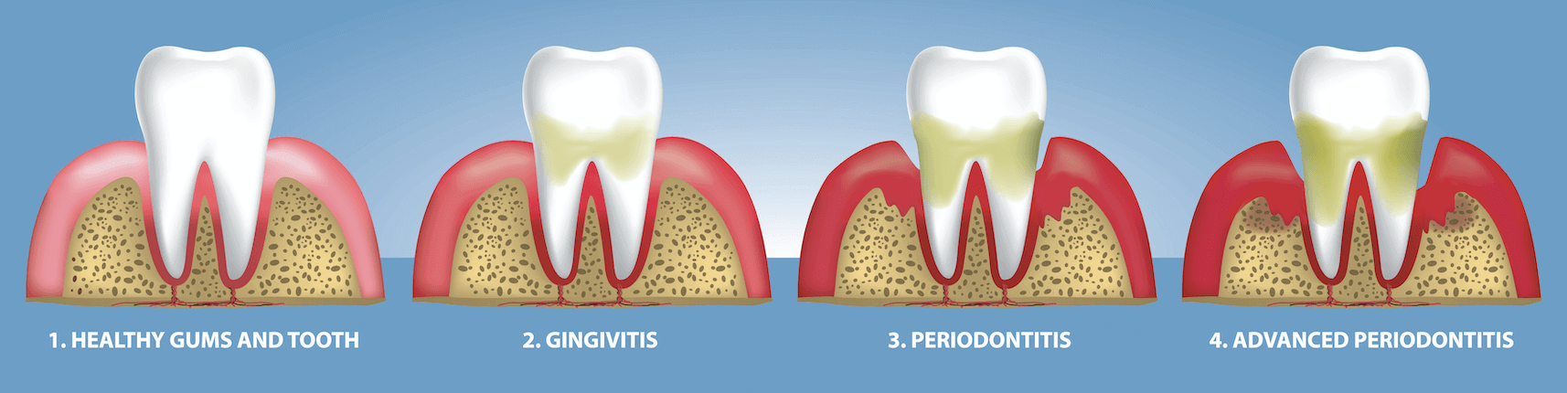 Illustration of the stages of gum disease