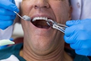 Dentist extracting a man's tooth