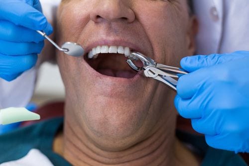 5 Reasons Why You May Need a Tooth Extraction | Gentle Care Dentistry