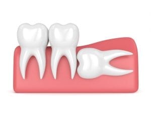 Illustration of an impacted tooth