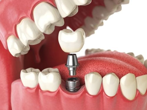 An illustration of how dental implants are installed into the mouth.