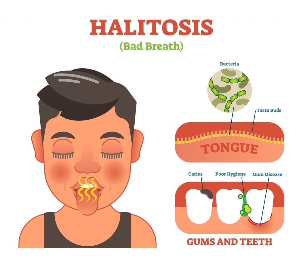 Halitosis, bad breath vector illustration diagram poster with persons mouth, tongue and teeth