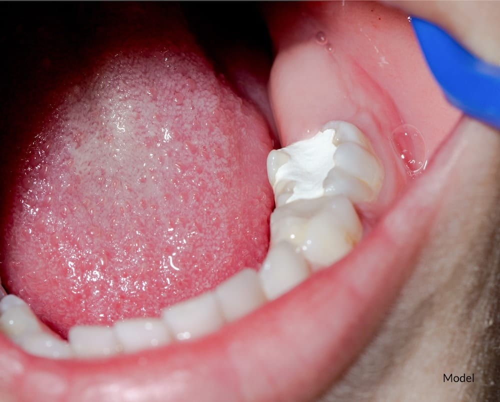 White amalgam fillings on molar teeth.