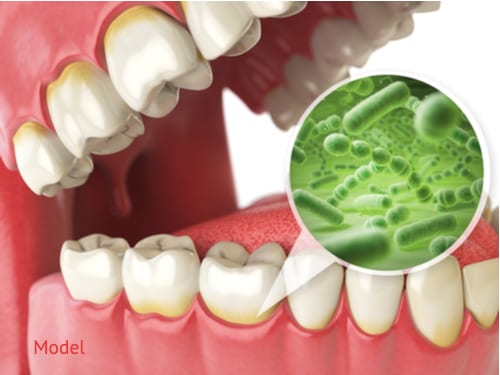 Model of bacteria and viruses around the tooth at the gum line.