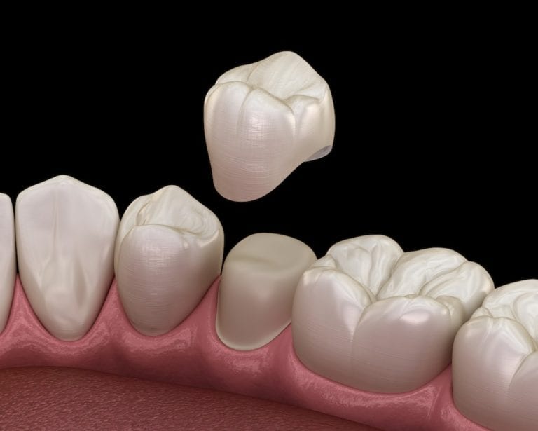 Do Crowns Get Cavities? Gentle Care Dentistry