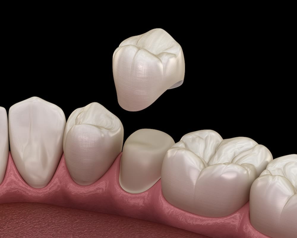 3D illustration of tooth restoration