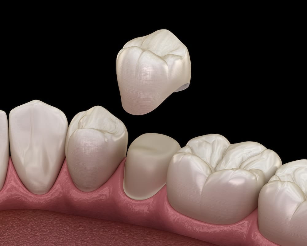 Can Dental Crowns Get Cavities?