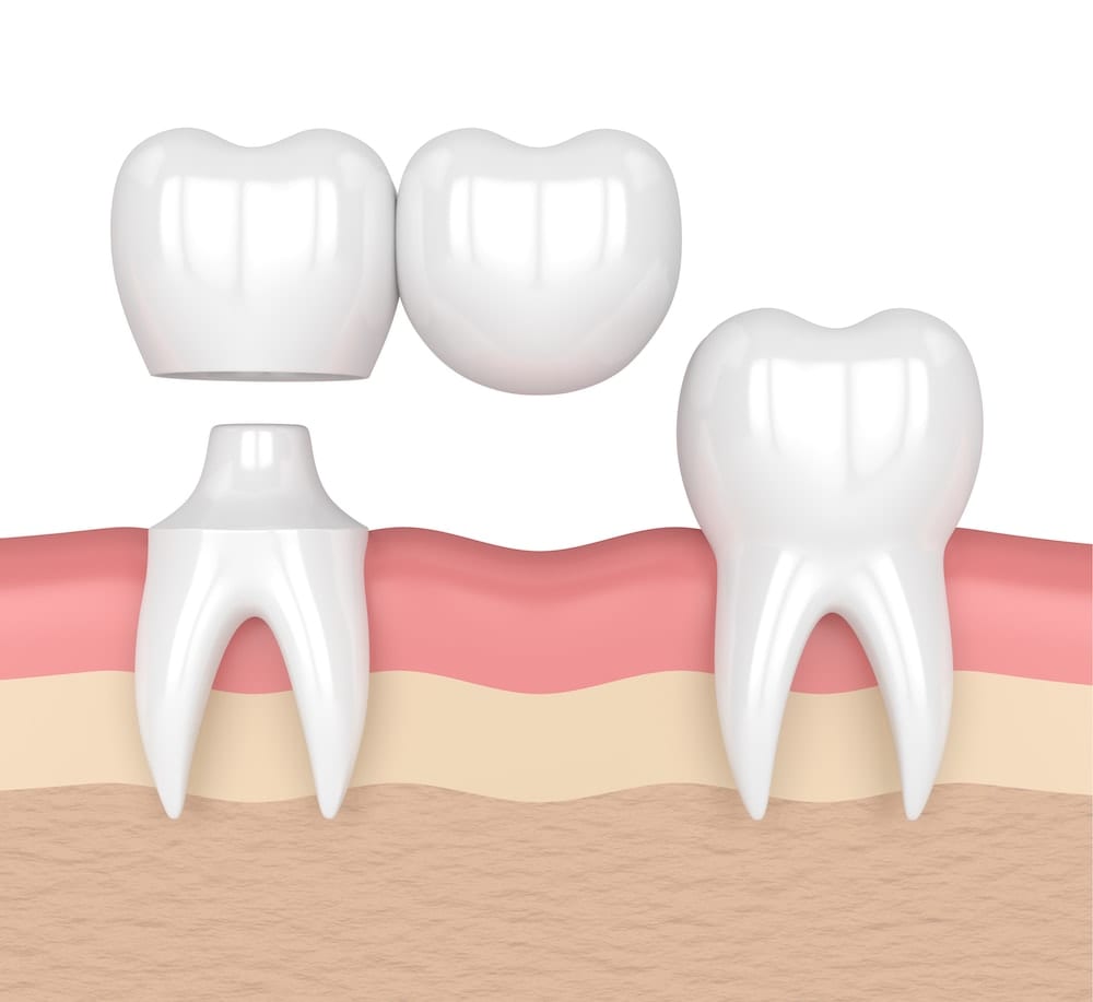 Illustration of dental bridge.