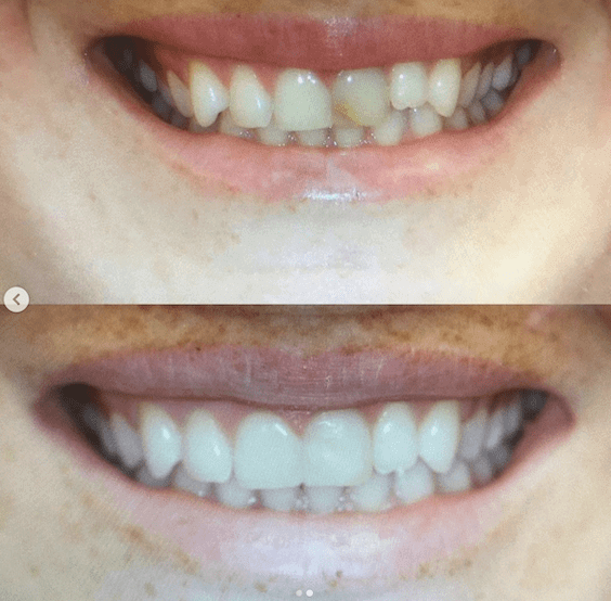 Gentle Care Dentistry before and after photos of dental work provided to a patient