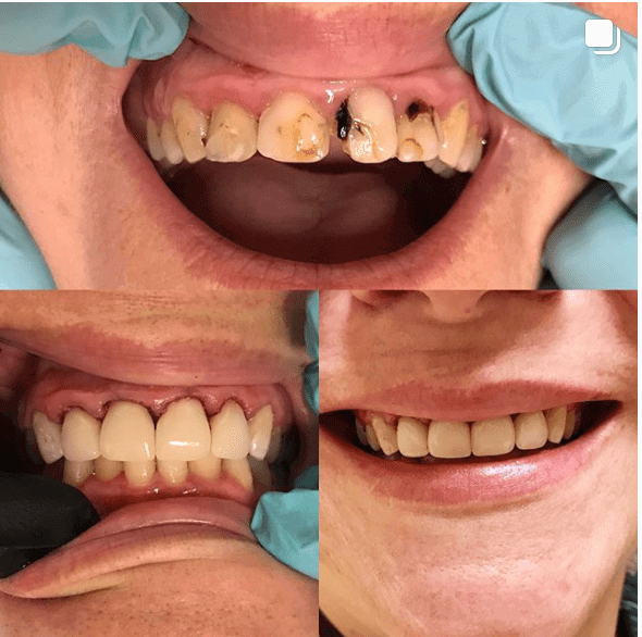 Gentle Care Dentistry dental crowns before and after photos