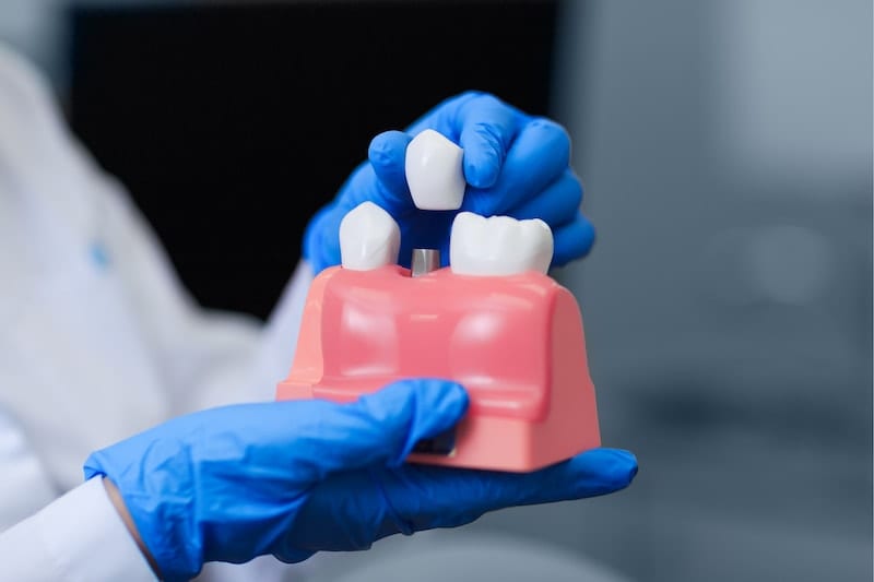 Real doctor holding model of teeth with dental implant, closeup. Tooth restoration. Installation of the dental implant. Dental prostheses. Artificial teeth with steel pin. Oral care and dentistry.