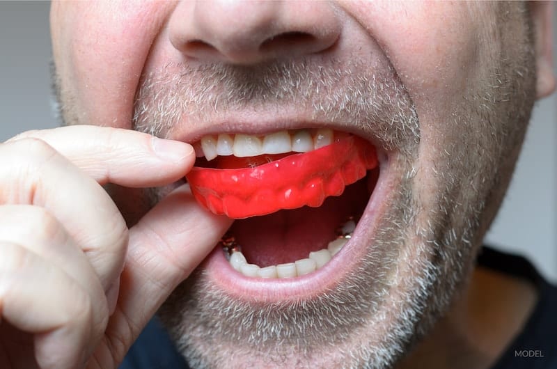 Man putting in a red mouth guard to protect his teeth from grinding (bruxism).