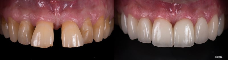 Teeth before and after a smile makeover.