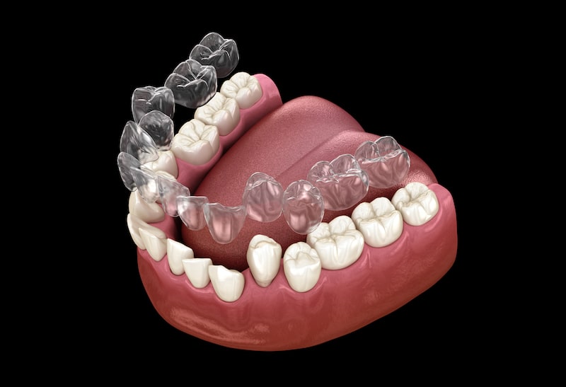 Clear dental aligners.
