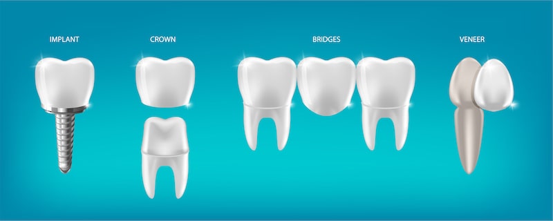 Cosmetic dental treatments: implant, crown, bridge, and veneer.