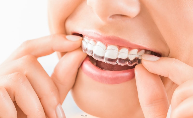 A woman removes her clear dental aligner.