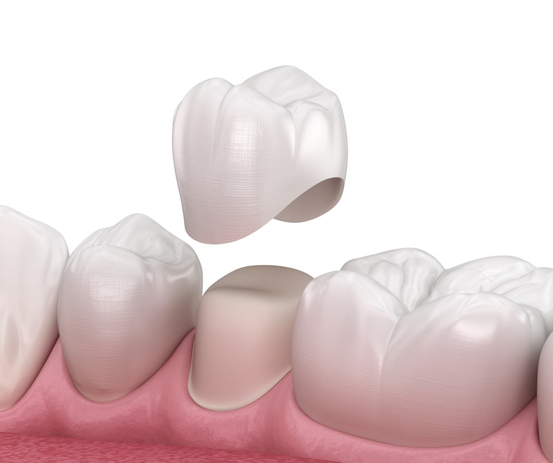 illustration of a row of teeth with a tooth-shaped cap (crown) hovering over a tooth