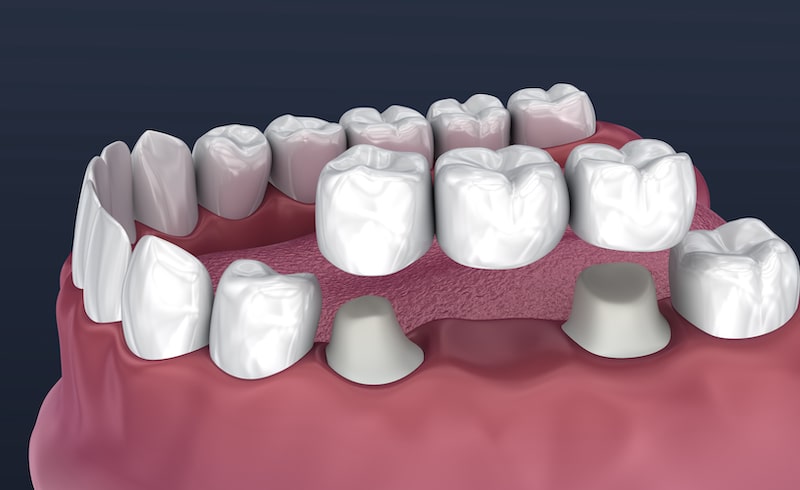 rendered image of the bottom jaw and bottom row of teeth with a bridge of three teeth being placed over a gap in the natural teeth