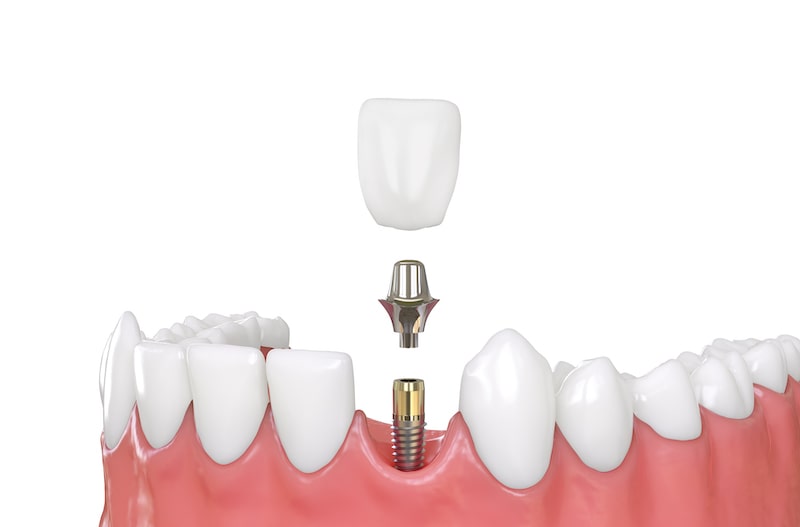 rendered image of a dental implant separated by piece: the screw inserted in the gum, the implant above that, and the cap or artificial tooth above